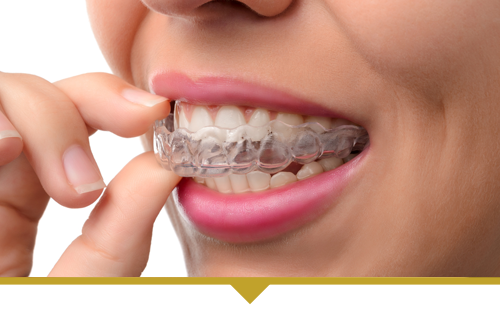 Invisalign